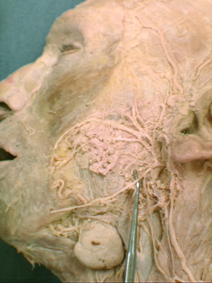 Marginal Mandibular Branch Of Facial Nerve Xxx Pics