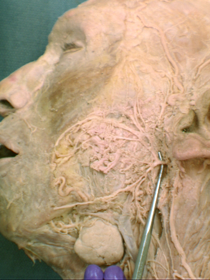 Facial Nerve Stylomastoid Foramen 75