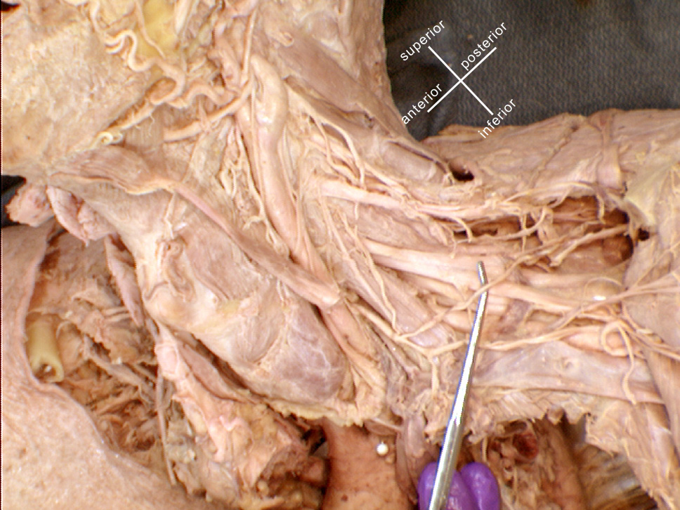 thyrocervical trunk