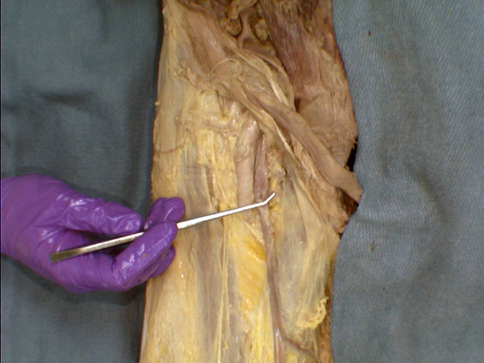 The gallery for --> Superficial Inguinal Lymph Nodes Cadaver